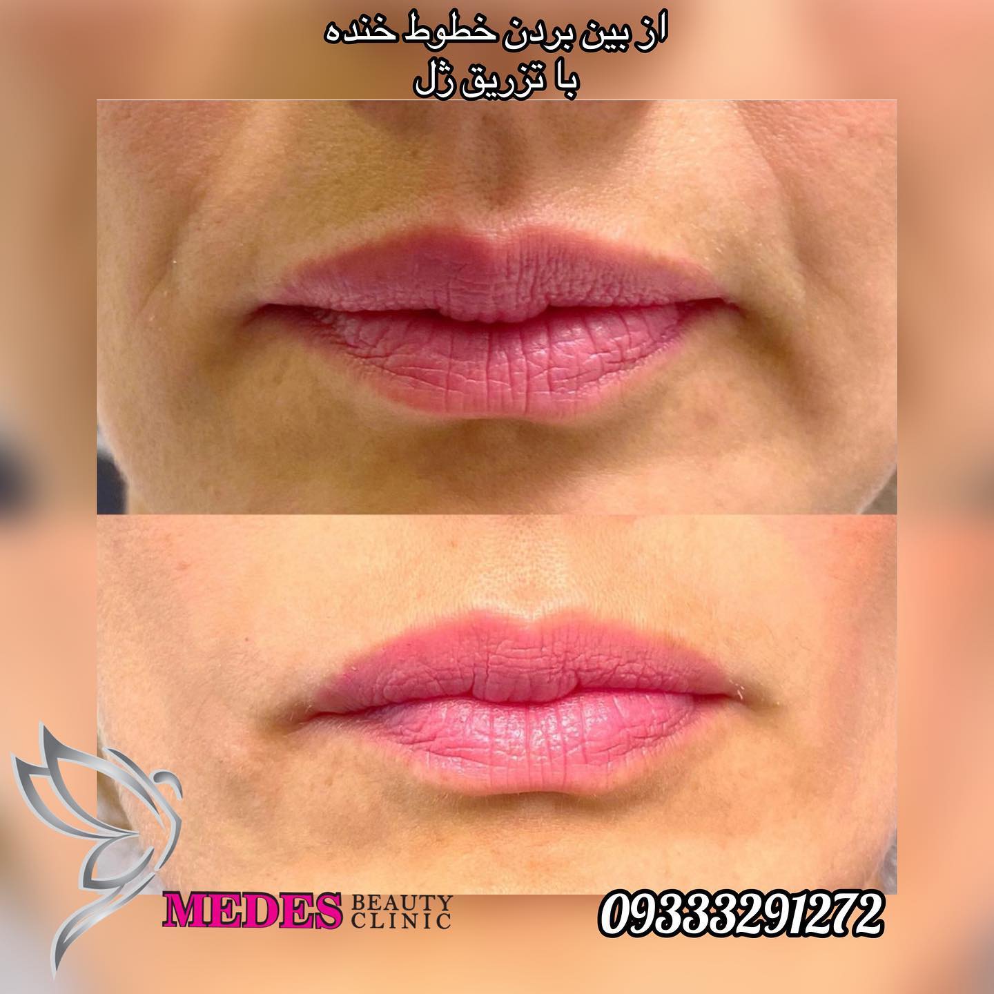 تزریق ژل خط خنده